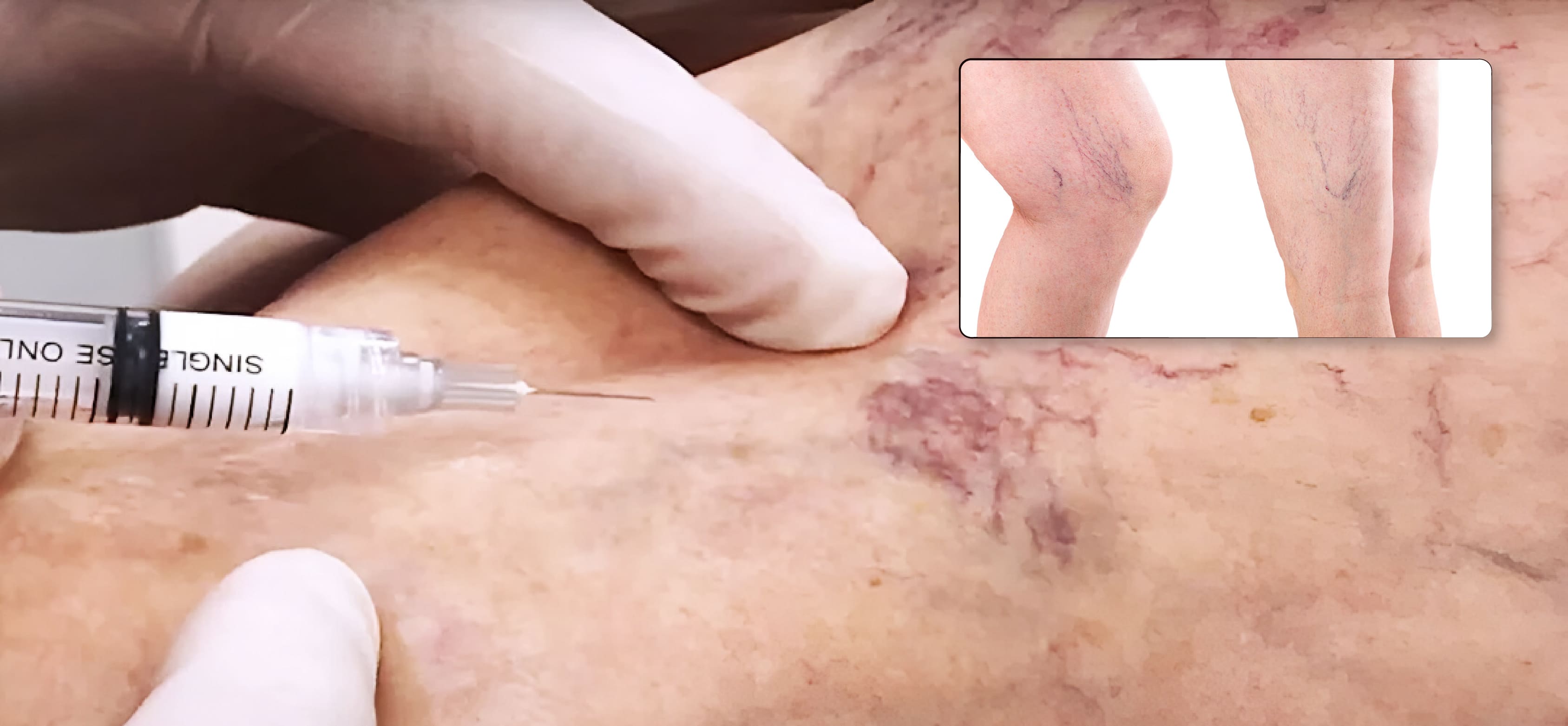 Varicose Veins - Sclerotherapy